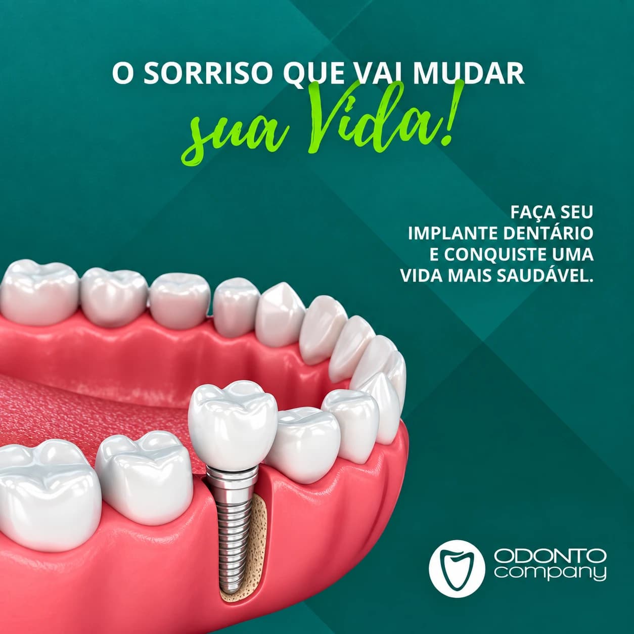 Arte de divulgação OdontoCompany sobre implantes dentários, com ilustração de um implante.